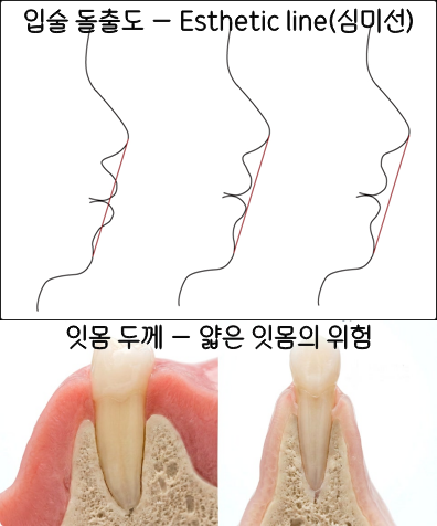 심미선 E-line 입술 돌출도와 잇몸 두께 교정 판단 기준