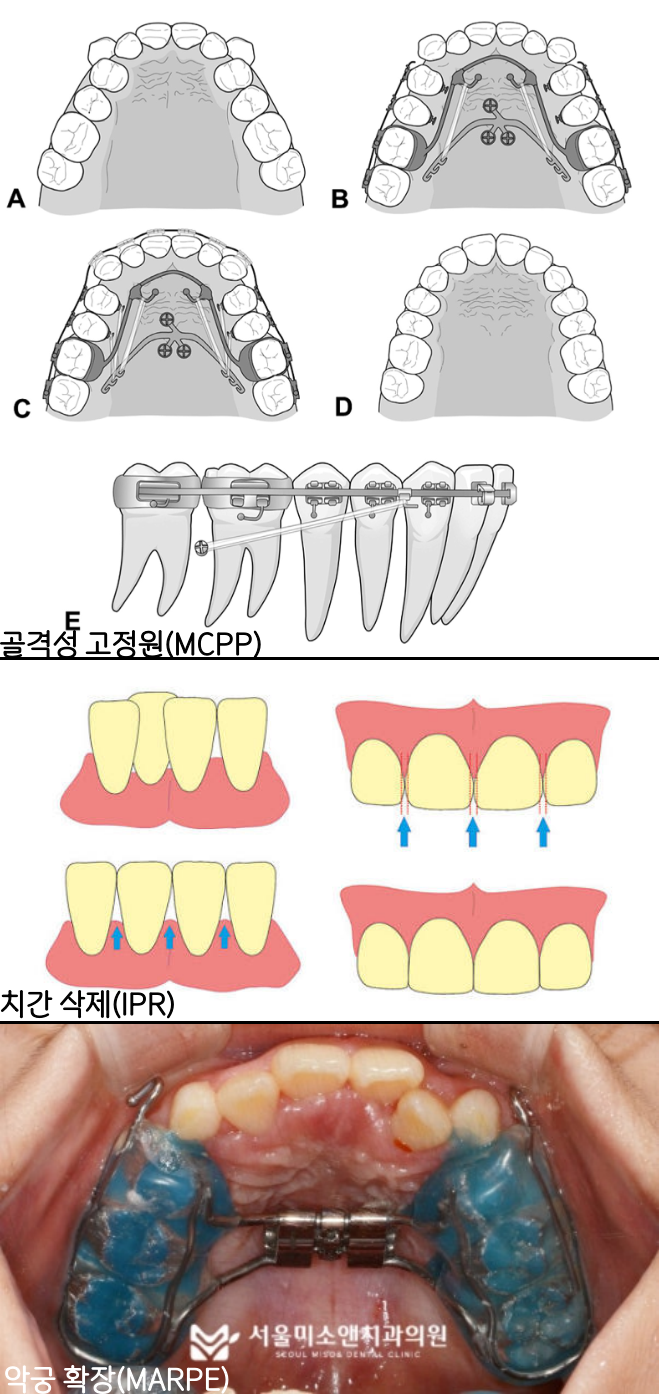 골격성 고정원(MCPP), 치간 삭제(IPR), 악궁 확장(MARPE) 어금니 후방이동 비발치 교정 방법