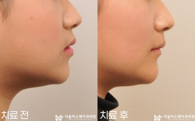 2. 노원구 치과 | 발치 교정 비발치 교정 차이 — 교정 전문의가 결정하는 4가지 기준 | 서울미소앤치과의원 [교정] - 서울미소앤치과의원 - 대표원장 칼럼