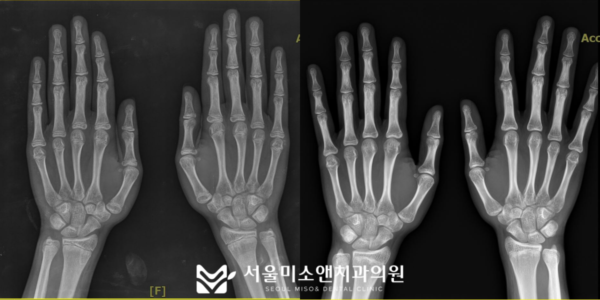 수골 방사선 사진으로 뼈나이 측정하는 방법
